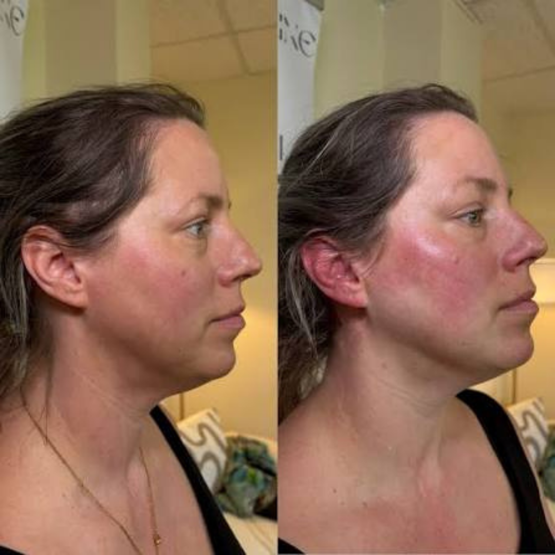 Reliefora™ Collagen Peptide Neck Lifting Ampoule