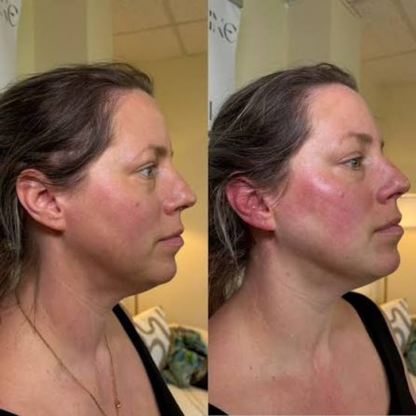 Reliefora™ Collagen Peptide Neck Lifting Ampoule