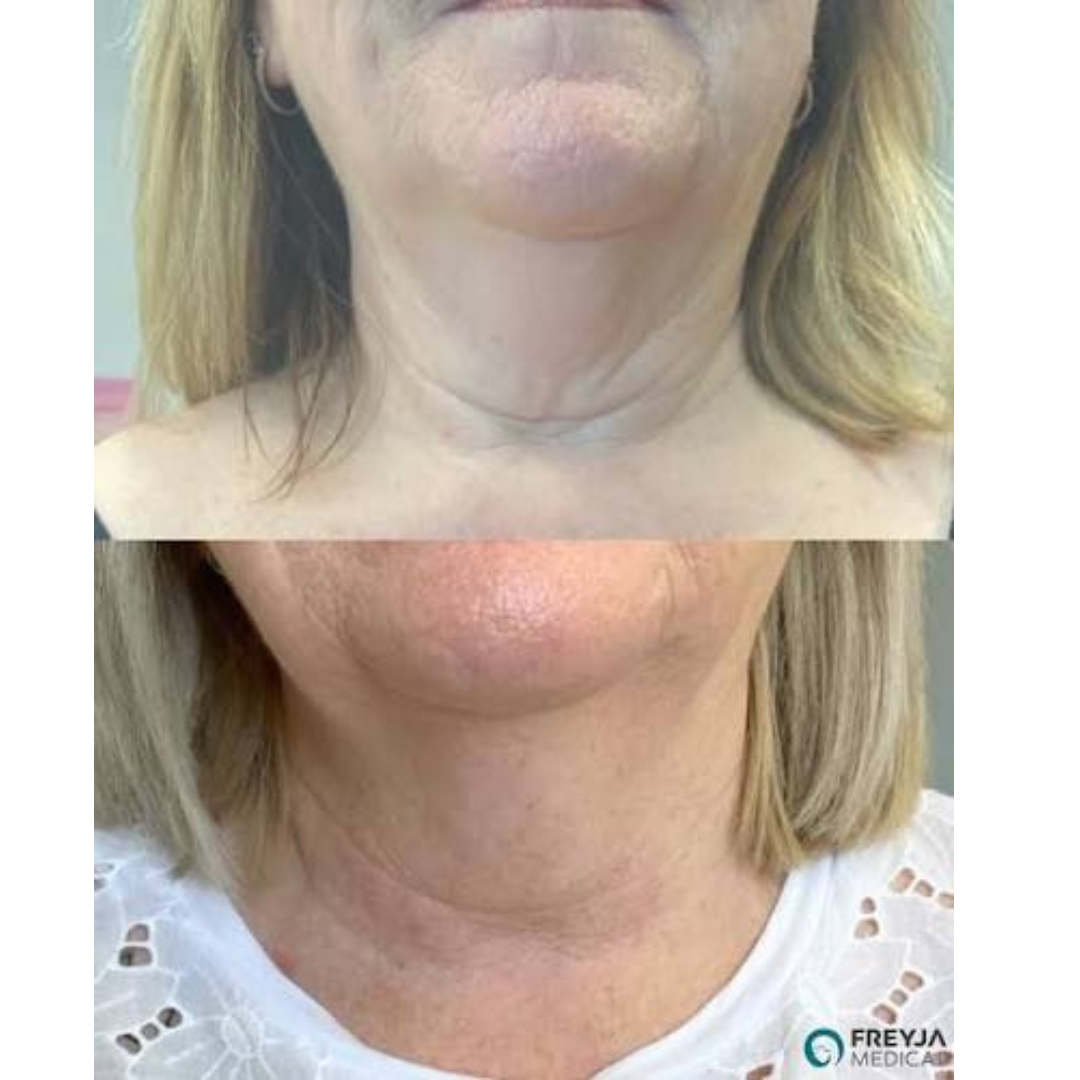 Reliefora™ Collagen Peptide Neck Lifting Ampoule