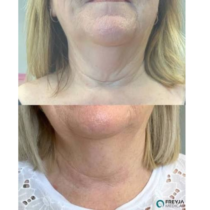 Reliefora™ Collagen Peptide Neck Lifting Ampoule