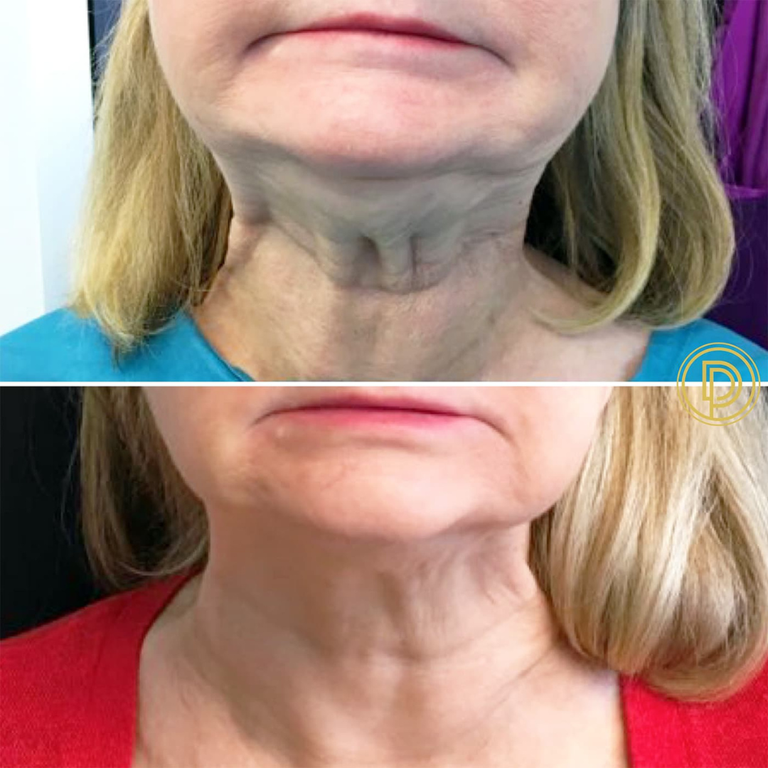 Reliefora™ Collagen Peptide Neck Lifting Ampoule