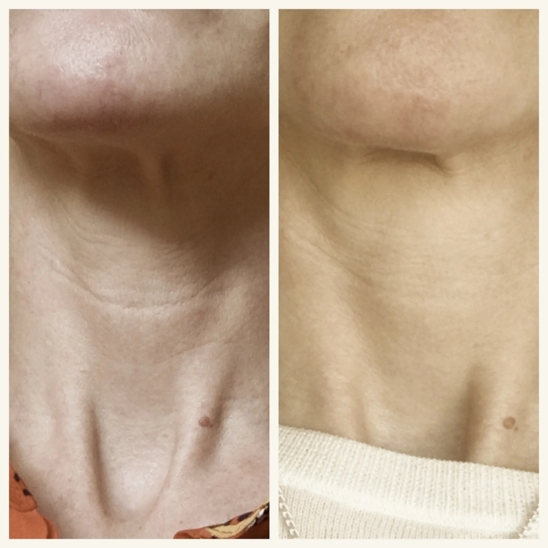 Reliefora™ Collagen Peptide Neck Lifting Ampoule