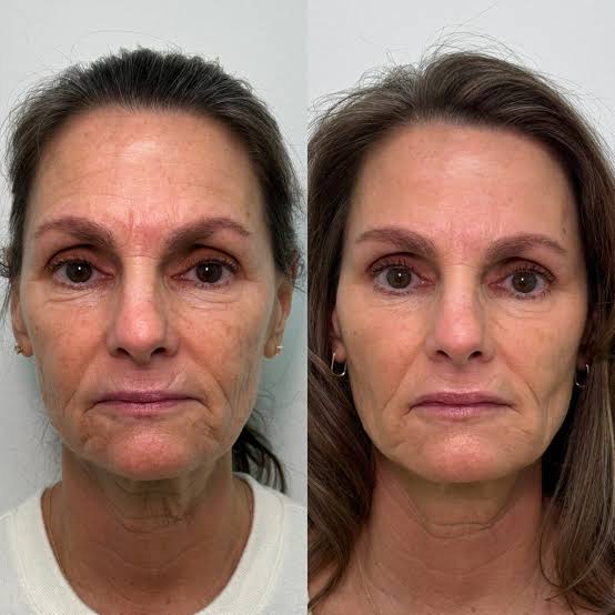 Reliefora™ Collagen Peptide Face Lifting Ampoule