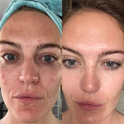 Reliefora™ Collagen Peptide Face Lifting Ampoule